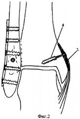 Способ оперативного лечения застарелых повреждений голеностопного сустава (патент 2283048)