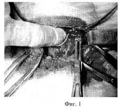 Способ хирургического лечения диффузного токсического зоба (патент 2281040)