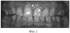 Способ эстетической реставрации зубов (патент 2529398)