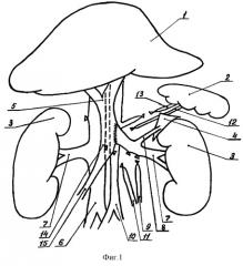 Способ односторонней портализации надпочечниковой и почечной крови (патент 2277863)
