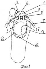 Корректор переднего отдела стопы (патент 2341234)