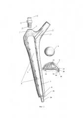 Устройство для эндопротезирования тазобедренного сустава (варианты) (патент 2611926)