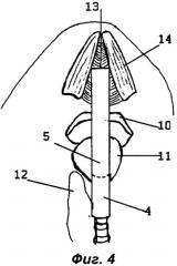 Способ операции на щитовидной железе и других органах переднего отдела шеи и ранорасширитель для ее выполнения (патент 2430686)