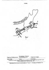 Устройство для остеосинтеза переломов нижней челюсти (патент 1743596)