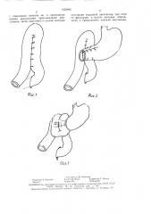 Способ резекции желудка (патент 1533662)