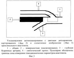 Способ диагностики функциональной полноценности сосудистого анастомоза после реконструктивных хирургических вмешательств (патент 2266711)