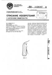 Способ транспозиции мыщелка культи плеча (патент 1158187)