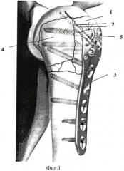 Способ оперативного лечения трехфрагментарных переломов проксимального отдела плечевой кости (патент 2447853)
