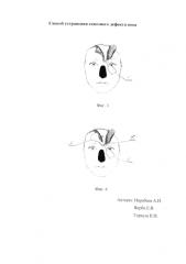 Способ устранения сквозного дефекта носа (патент 2580660)