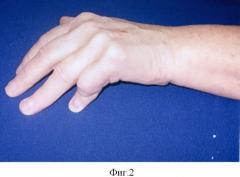 Способ лечения сгибательно-разгибательной контрактуры пальцев кисти (патент 2421169)