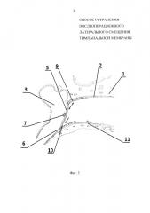 Способ устранения послеоперационного латерального смещения тимпанальной мембраны (патент 2648177)