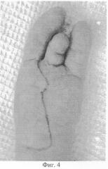 Способ реконструкции пальцев при врожденной патологии кисти (патент 2307612)