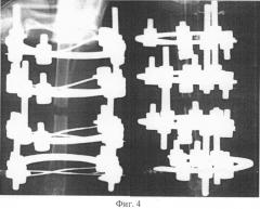 Способ моделирования ложного сустава при переломе костей голени и устройство для его осуществления (патент 2523622)