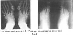 Способ лечения вальгусной деформации первого пальца стопы (патент 2509539)