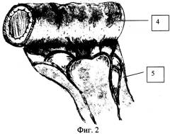 Способ трансплантации трахеи тонкой кишкой (патент 2306877)