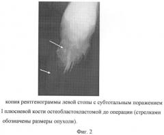 Способ оперативного лечения больных с субтотальным дефектом плюсневой кости и плоскостопием (патент 2412662)