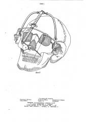 Аппарат для лечения переломов верхней челюсти (патент 938971)