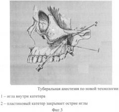 Способ проводниковой анестезии (патент 2426563)