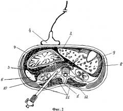 Способ лечения острого панкреатита (патент 2344828)