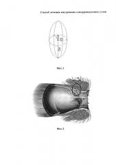 Способ лечения внутренних геморроидальных узлов (патент 2620755)