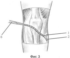 Способ хирургического лечения застарелого разрыва передней крестообразной связки коленного сустава (патент 2347541)