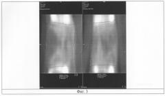 Способ исследования плотности дистракционного регенерата при компьютерной томографии (патент 2289314)