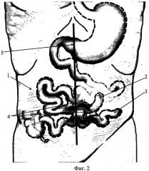 Способ формирования кишечной стомы (патент 2532304)