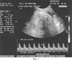 Способ оценки состояния плода и прогнозирования состояния новорожденного при сахарном диабете матери по показателям кровотока при допплерометрическом исследовании (патент 2251976)