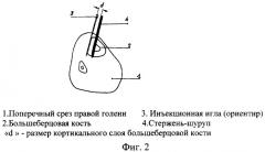 Способ чрескостного остеосинтеза костей голени (патент 2261675)