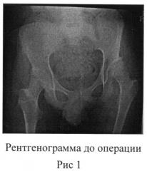 Способ остеотомии таза при лечении дисплазии вертлужной впадины у детей с дцп (патент 2501532)