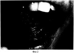 Лекарственное средство для лечения экссудативно-гиперемической и эрозивно-язвенной форм красного плоского лишая слизистой оболочки полости рта (патент 2549498)
