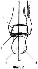 Способ хирургического лечения плосковальгусной деформации стопы у детей с детским церебральным параличом (патент 2345727)