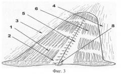 Способ протезирующей герниопластики срединных вентральных грыж (патент 2400160)