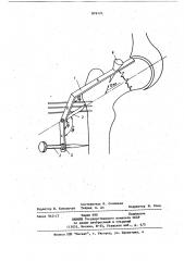 Ортопедический кондуктор (патент 876121)