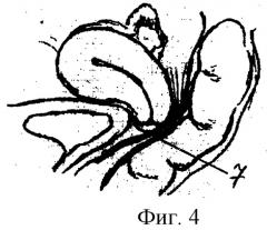 Способ хирургического лечения влагалищного энтероцеле (патент 2281705)