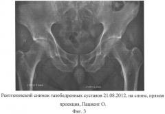 Способ лечения асептического некроза головки бедренной кости и сборы лекарственных растений для осуществления лечения (патент 2558476)