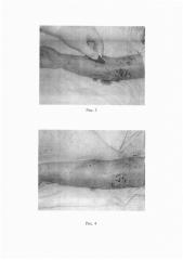 Способ комплексного лечения пограничных ожогов кожи (патент 2618914)