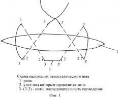 Способ ушивания ран паренхиматозных органов (патент 2346660)