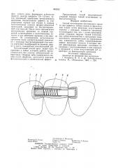 Способ изготовления мостовидного протеза при дефектах зубных рядов во фронтальном отделе (патент 952240)