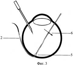 Способ проведения интраокулярной брахитерапии (патент 2325139)