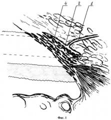 Способ лечения открытоугольной глаукомы (патент 2538233)