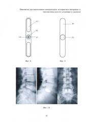 Имплантат для межтелового спондилодеза из пористого материала и имплантовод для его установки и удаления (патент 2624350)