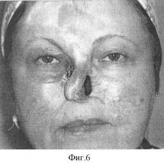 Способ неоднократной репродукции протеза носа (патент 2352296)