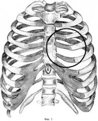 Костно-пластический способ закрытия дефекта ребер грудной клетки (варианты) (патент 2551617)