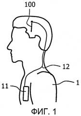 Система электродов для глубокой стимуляции головного мозга (патент 2467773)