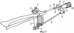 Способ восстановления движений в коленном суставе при контрактуре (патент 2410064)