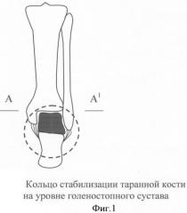 Модель системы стабилизации таранной кости при переломовывихах голеностопного сустава (патент 2340010)