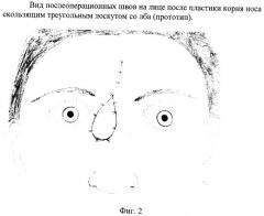 Способ пластики корня носа и медиального угла глаза (патент 2375000)