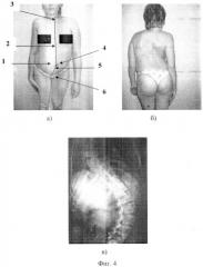 Способ определения смещения беременной матки при сколиозе (патент 2454175)