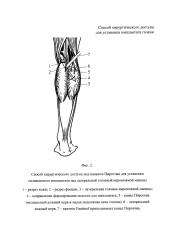 Способ хирургического доступа для установки имплантата голени (патент 2626274)